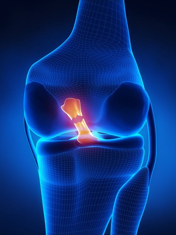 St Ives Clinical Physio - ACL injury