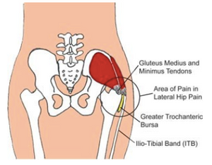 OUTER HIP PAIN, OUTER HIP PAIN [Gluteal Tendinopathy Vs. Hip Bursitis]  🙋Do you have outer hip pain? Do you have hip discomfort when lying on your  side? ✓If you have