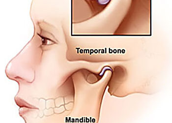 Is Your Jaw (TMJ) Causing Your Headache?