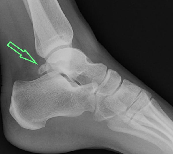 Stress Fracture Of The Talus - Ankle - Conditions - Musculoskeletal - What  We Treat 