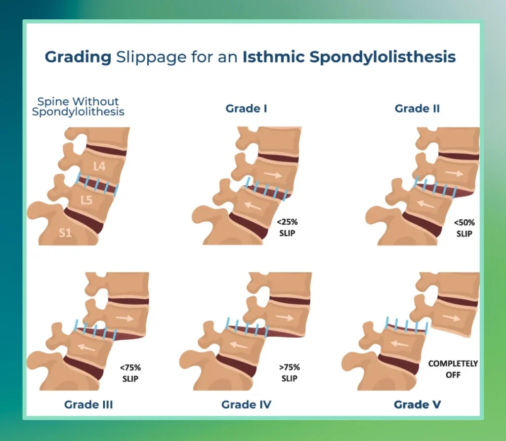 Grading Slippage of One Vertebra