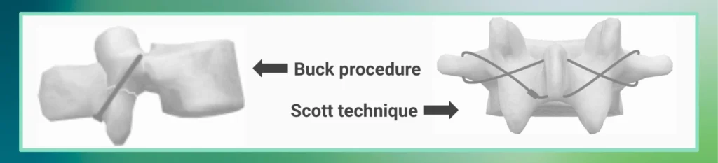 Types of surgery for Lower Back Stress Fracture
