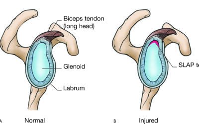 Shoulder SLAP Tear Rehabilitation