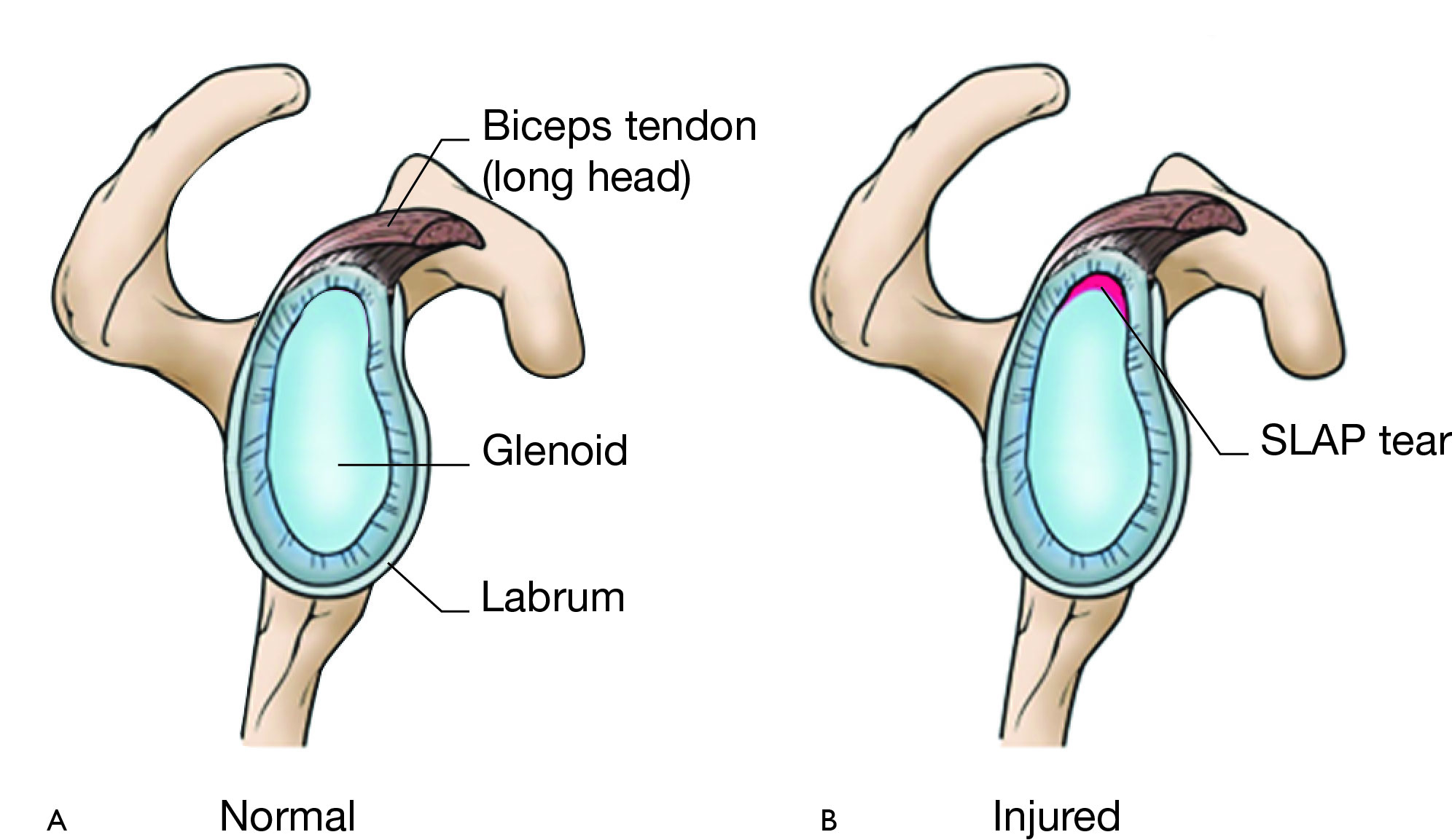 slap tear rehabilitation